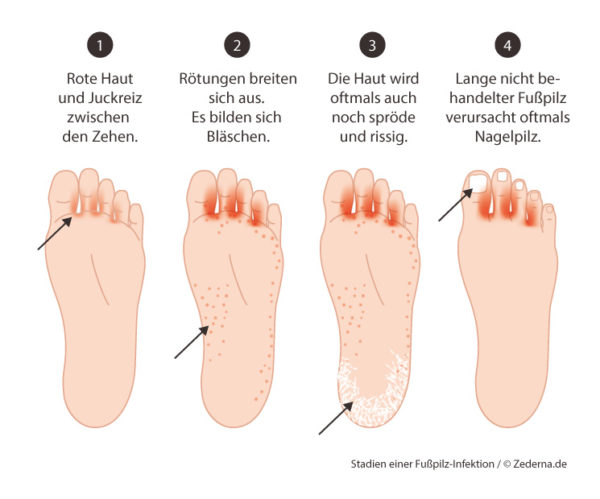 Wie Sie Fußpilz erkennen und den Fußpilz behandeln können